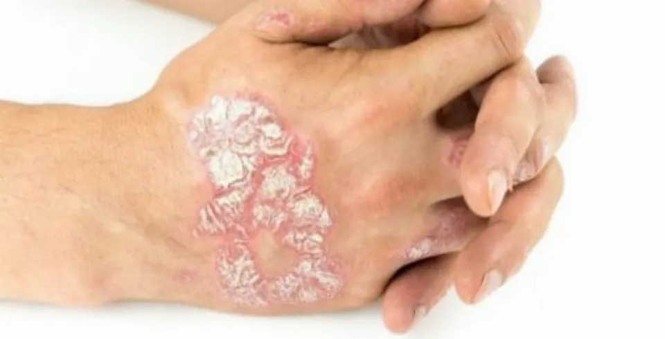Лечение псориаза Нафталаном